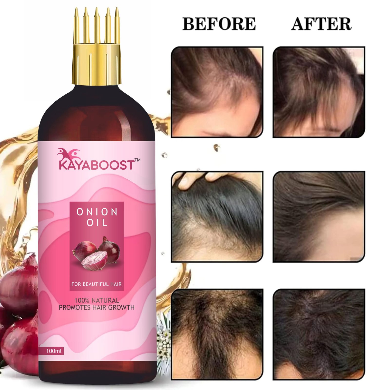 Kayaboost Onion Hair Oil 100ml (Pack of 3)– Natural Red Onion Oil for Hair Growth & Hair Fall Control | With Amla, Hibiscus & Jojoba Oil